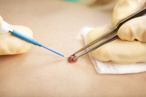 Tumor & Mole Removal Tumor & Mole Removal in Long Island Dermatology